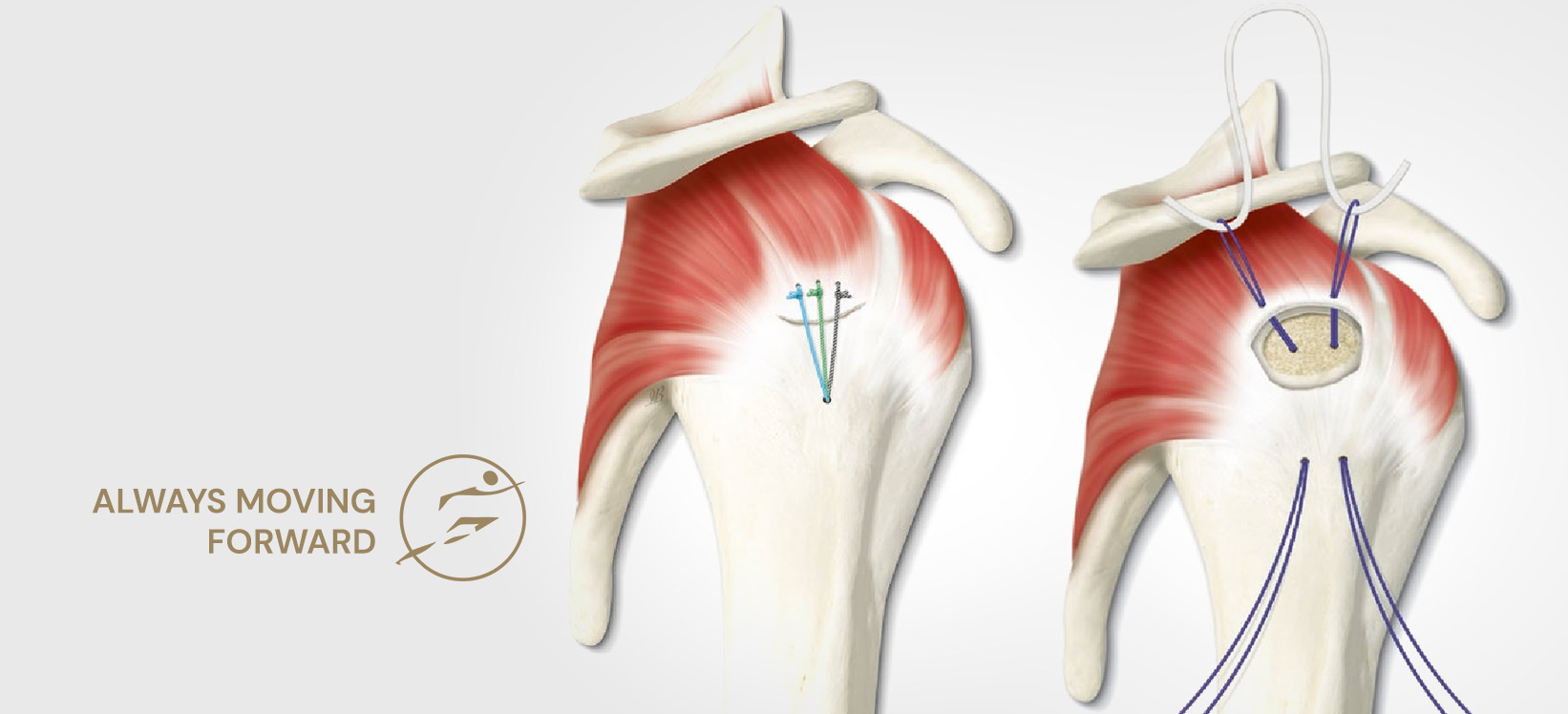 Fix rotator cuff discount