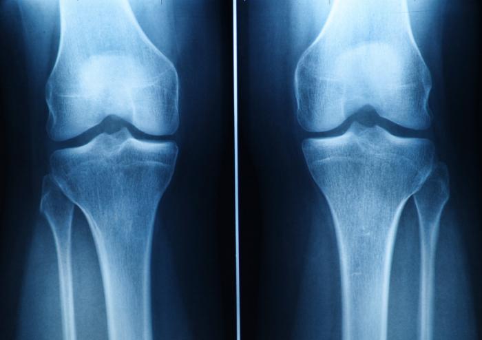 Knee Cartilage Injury Symptoms